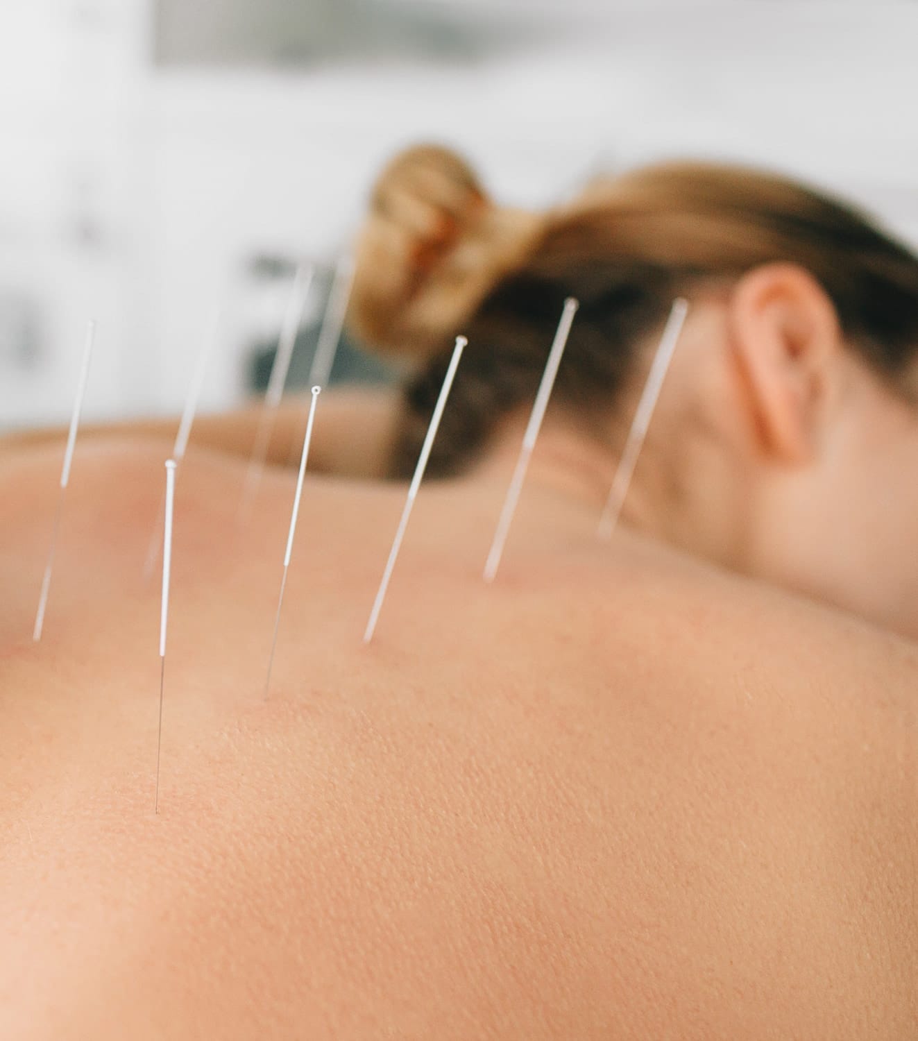 a woman lays face down. acupuncture needles are along her spine. Acupuncture Duluth, MN