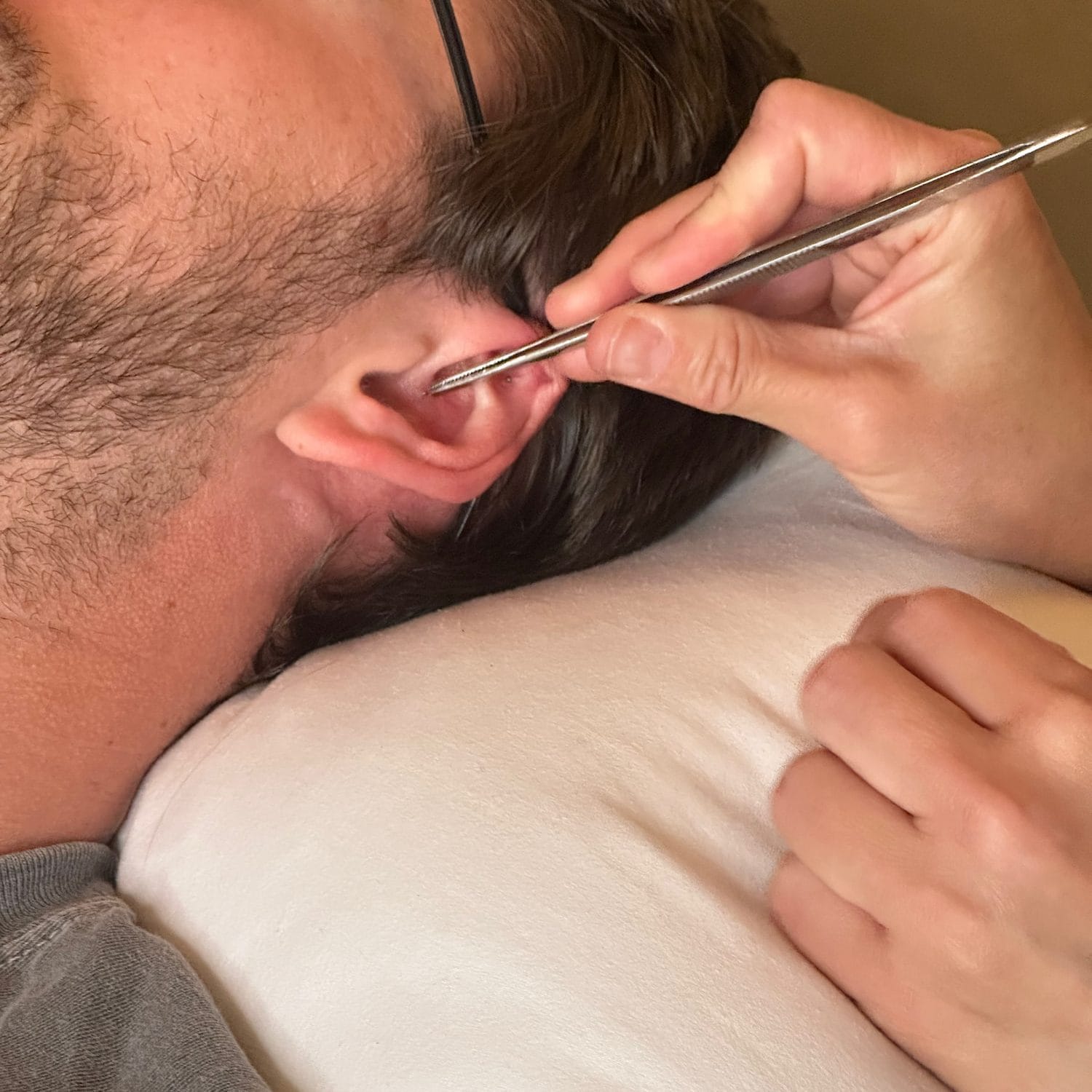 Acupuncturist Jakki Overby places an ear beat into the ear of a client using tweezers. The ear bead is a small metal bead held in place by a clear adhesive similar to a very small bandage.